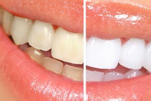 Отбеливание зубов