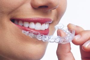 Исправление прикуса